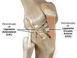 Reconstrução Ligamentar